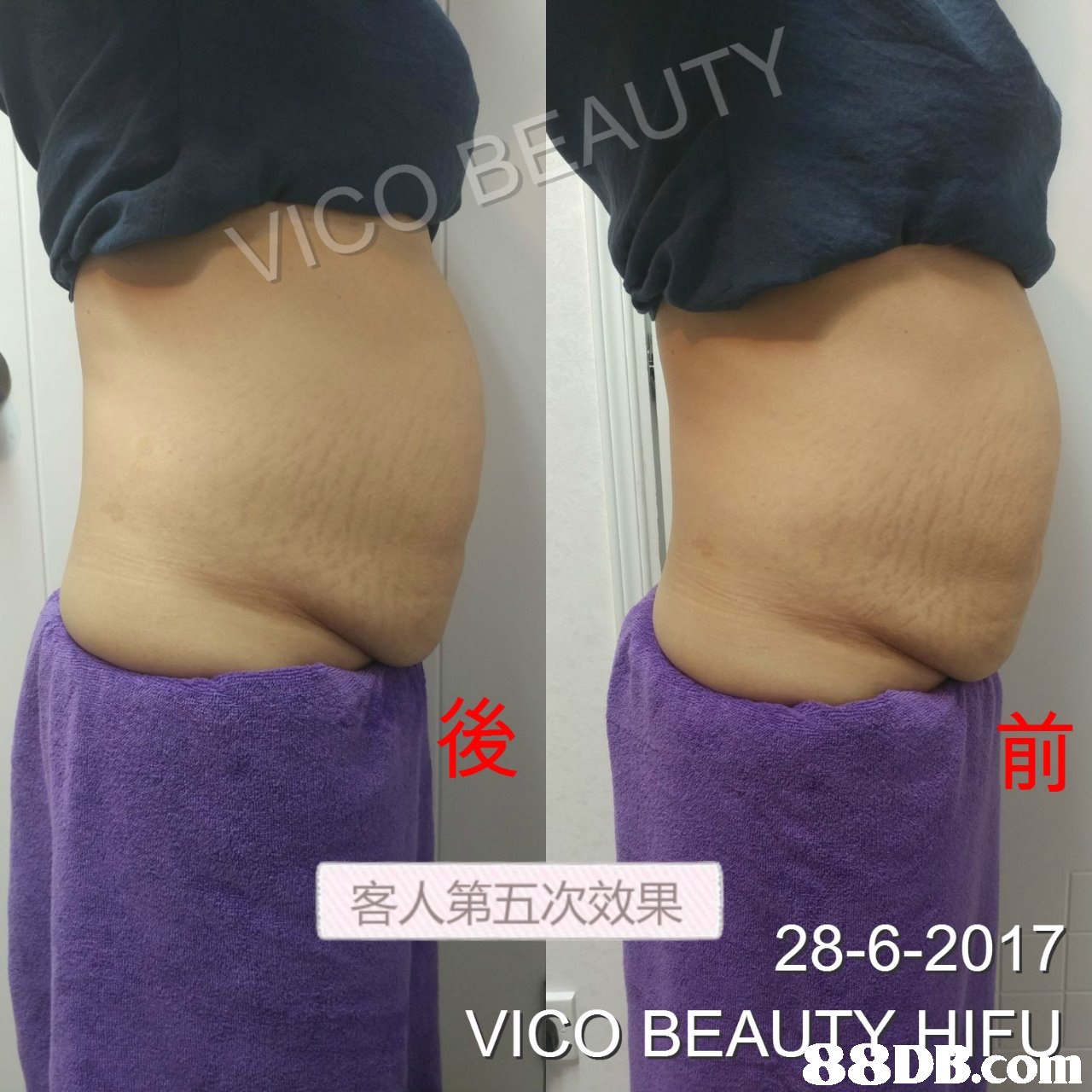 後 客人第五次效果 28-6-2017 VICO BEA  abdomen,purple,joint,shoulder,thigh