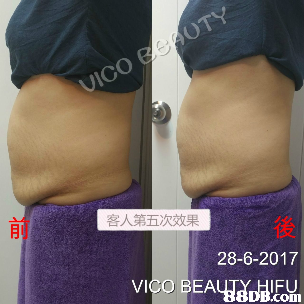 VICO AUTY 客人第五次效果 後 28-6-2017 VICO BEAUTaplEon IFU .com  abdomen,purple,joint,shoulder,active undergarment
