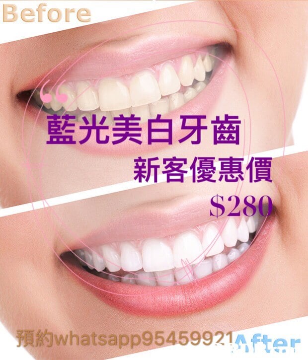 Before 藍光美白牙齒 新客優惠價 $280 預約whatsapp95459921After  smile,tooth,chin,jaw,mouth