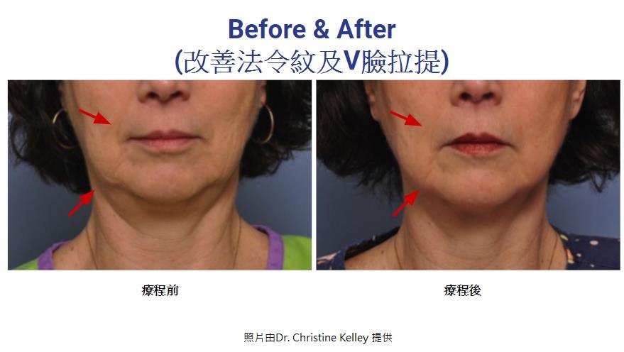 Before & After (改善法令紋及V臉拉提) 療程前 療程後 照片由Dr. Christine Kelley提供  face