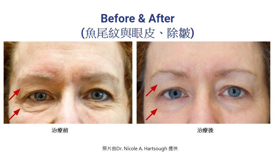 Before & After (魚尾紋與眼皮、除皺) 治療前 治療後 照片由Dr. Nicole A. Hartsough提供  eyebrow