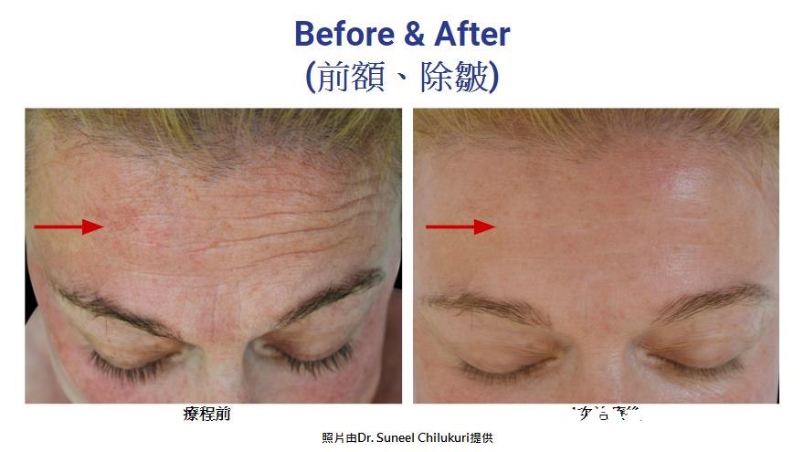 Before & After (前額、除皺) 療程前 照片由Dr. Suneel Chilukuri提供  eyebrow